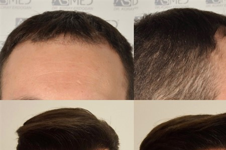 Ayurvedic and Panchakarma Treatment for Hair Loss