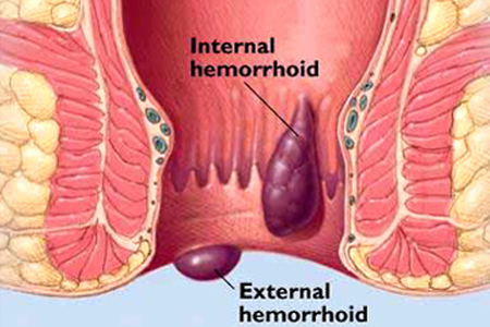 piles treatment in chandiagrh