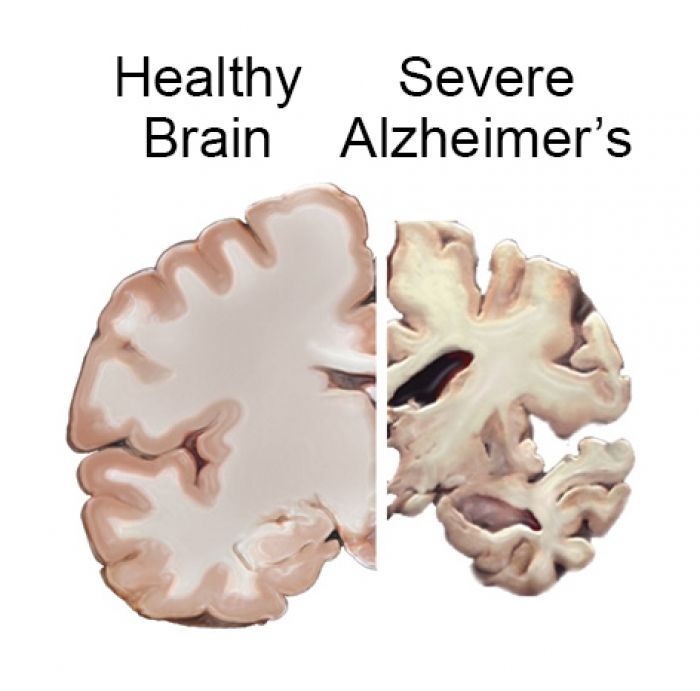 Alzheimer