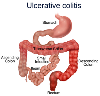 ulcerative-colitis