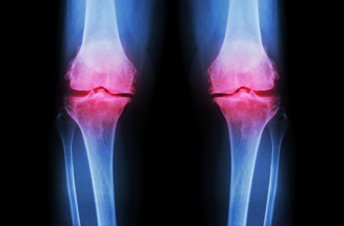 Ayurvedic Treatment of Osteoarthritis