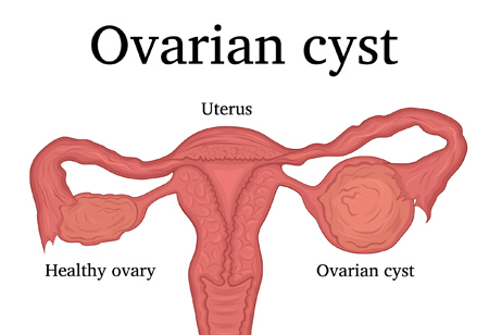 Ovarian Cyst