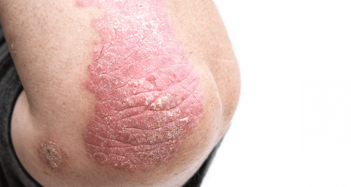 Ayurvedic Treatment for Psoriasis