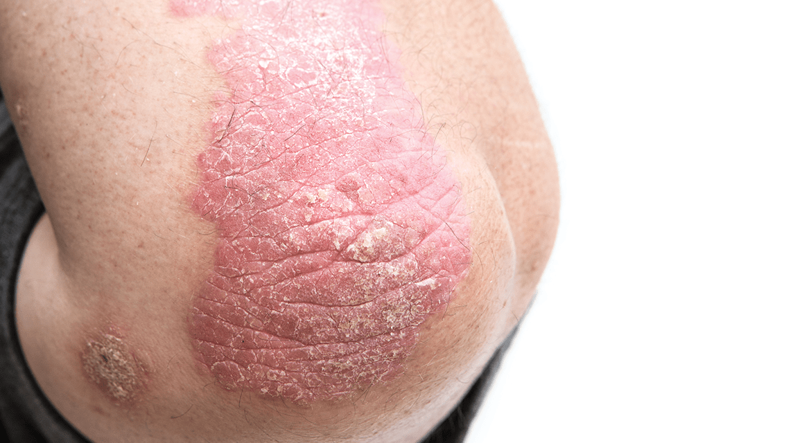 Ayurvedic Treatment for Psoriasis