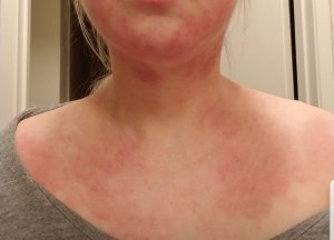 Eczema