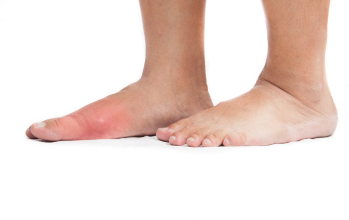 Ayurvedic treatment for Gout