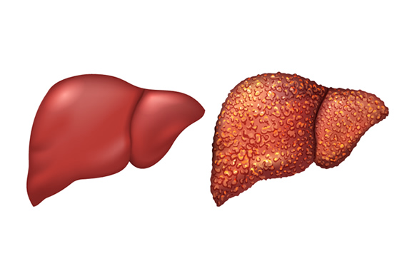 Liver Cirrhosis