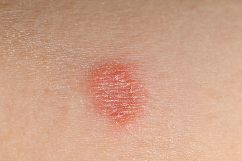 Ayurvedic Treatment of Ringworm