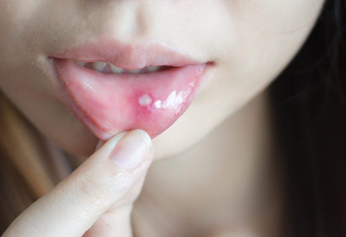 Mouth-Ulcers
