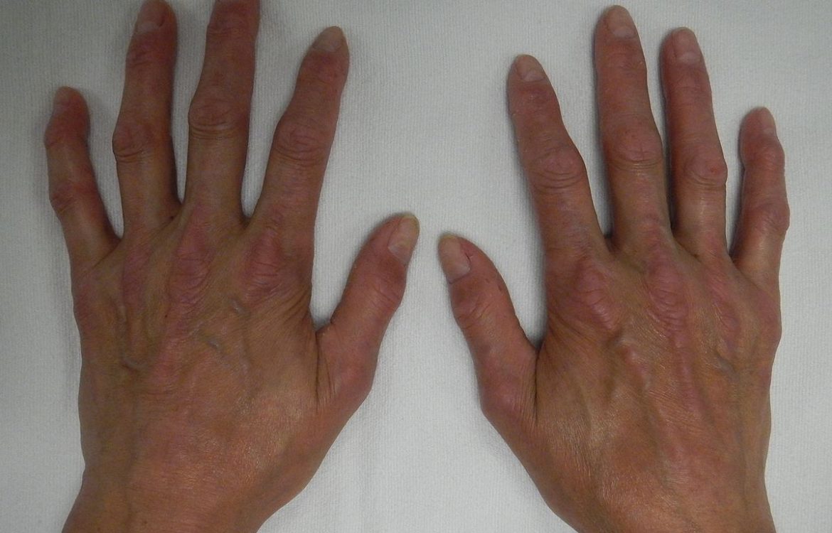 Scleroderma