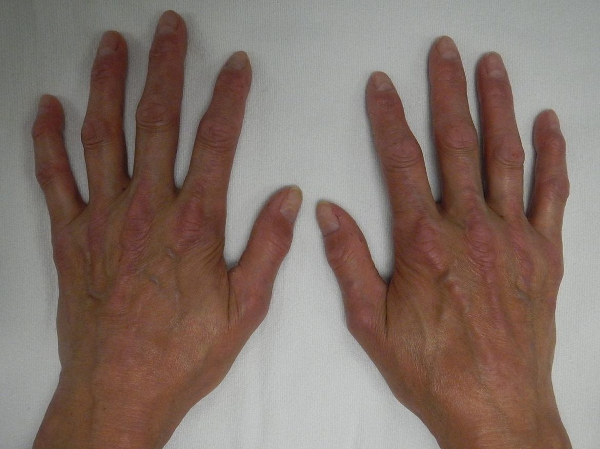 Scleroderma