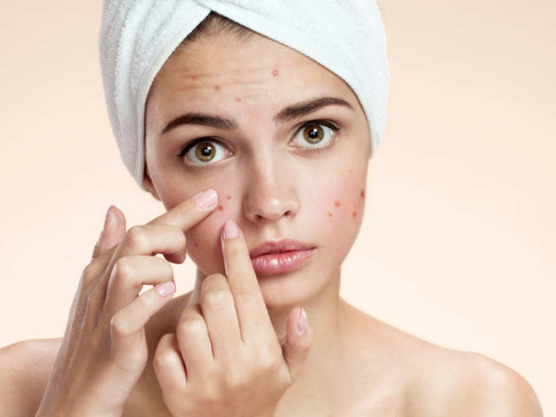 Ayurvedic Treatment For Acne, Herbal Remedies For Acne