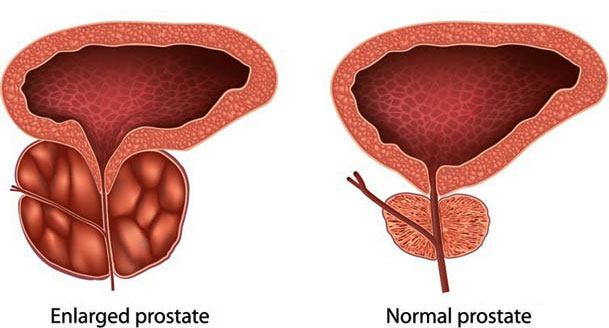 Benign Prostatic Hyperplasia