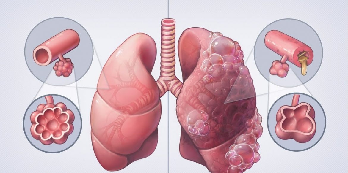 Bronchitis