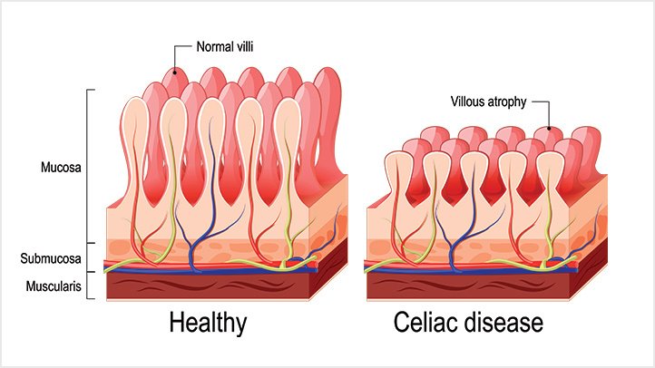 Celiac-Disease