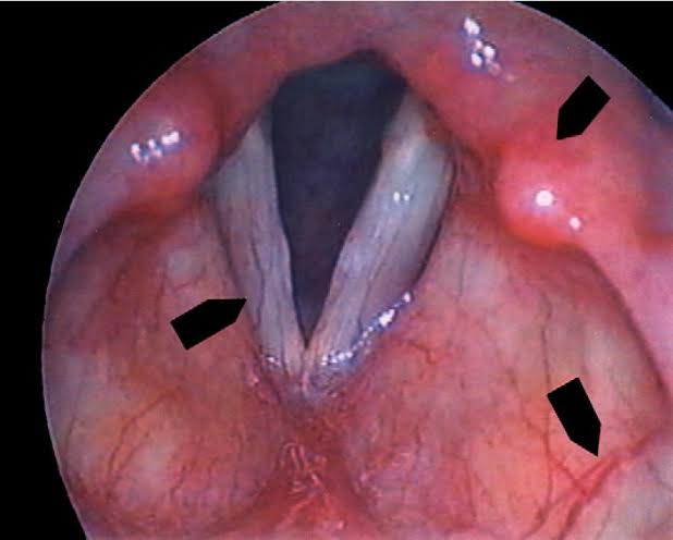 Chronic-Laryngitis