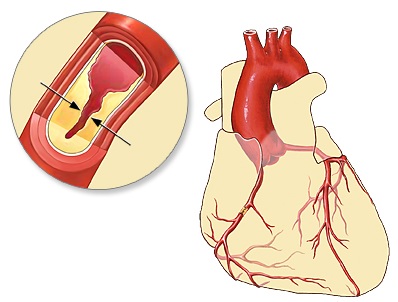 ischemic heart disease