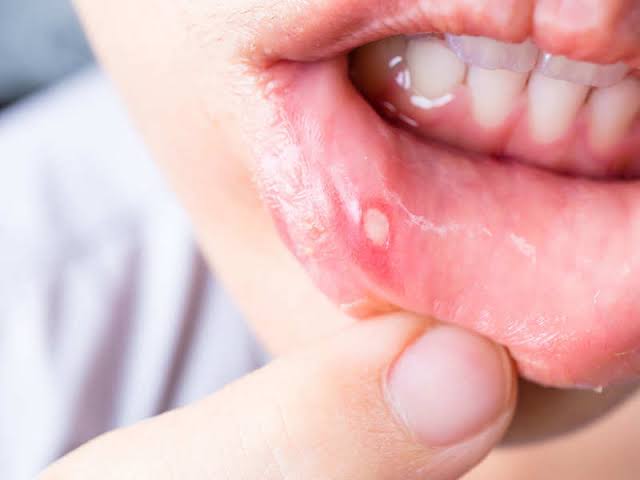 mouth-ulcers