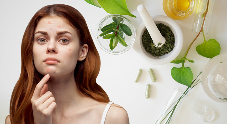 What is the ayurvedic treatment for removal of acne