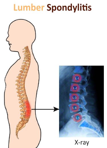 Ayurvedic Treatment for Lumbar Spondylosis