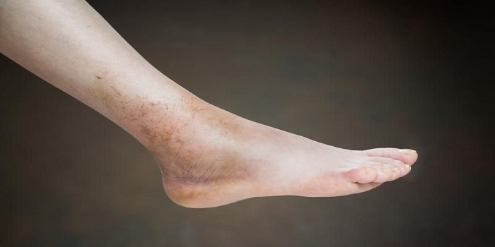 gout symptoms, gout diagnosis, gout treatment, gout cause, foods that cause gout, first sign of gout, gout diet