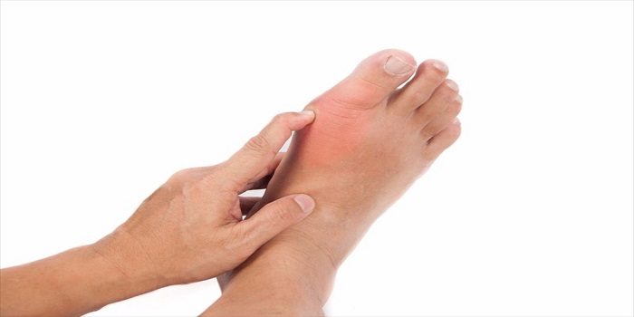 gout treatment, foods that cause gout, gout symptoms, gout diet, gout in knee, the first sign of gout, gout pain relief