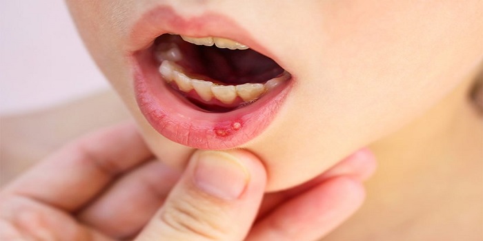 How to treat a painful mouth ulcer with Ayurveda