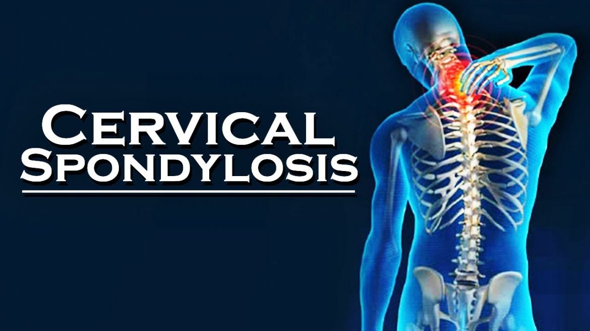 cervical spondylosis