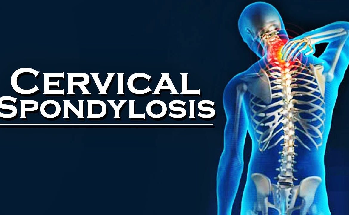 cervical spondylosis