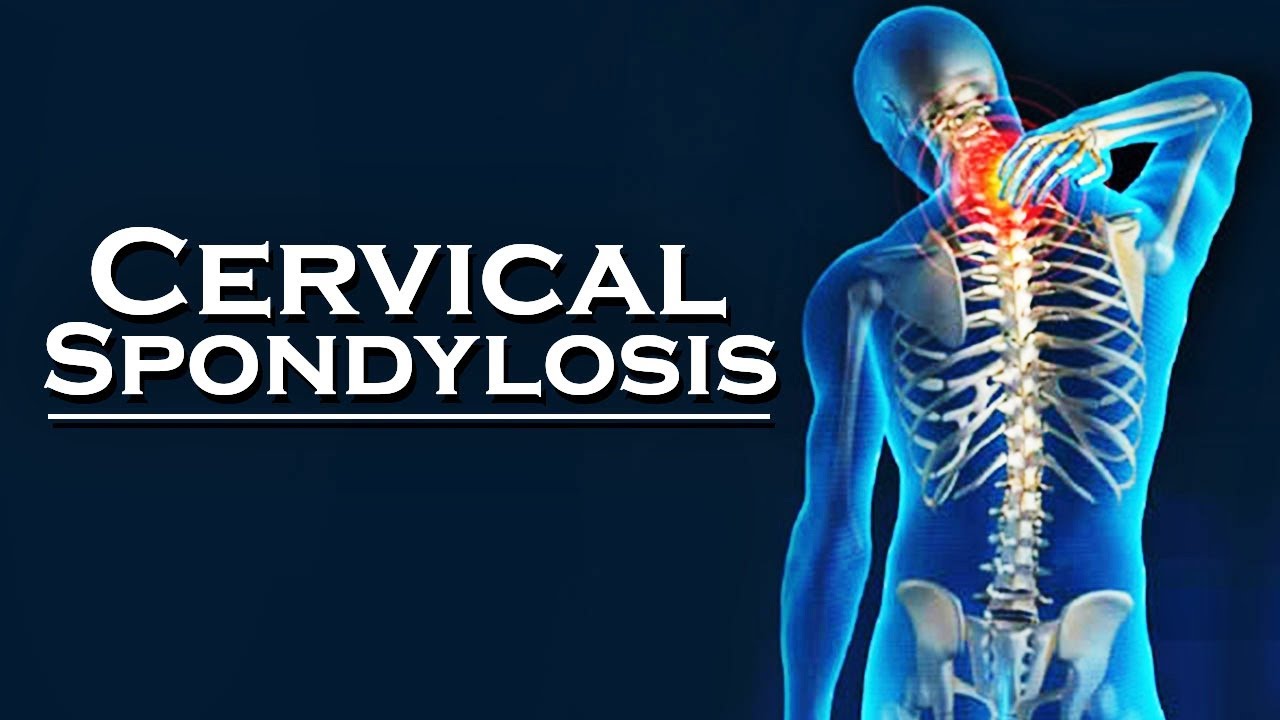 Cervical Spondylosis Symptoms