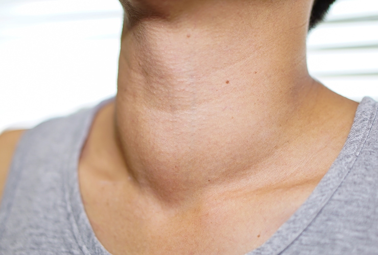 home-remedies-for-goiter-feat