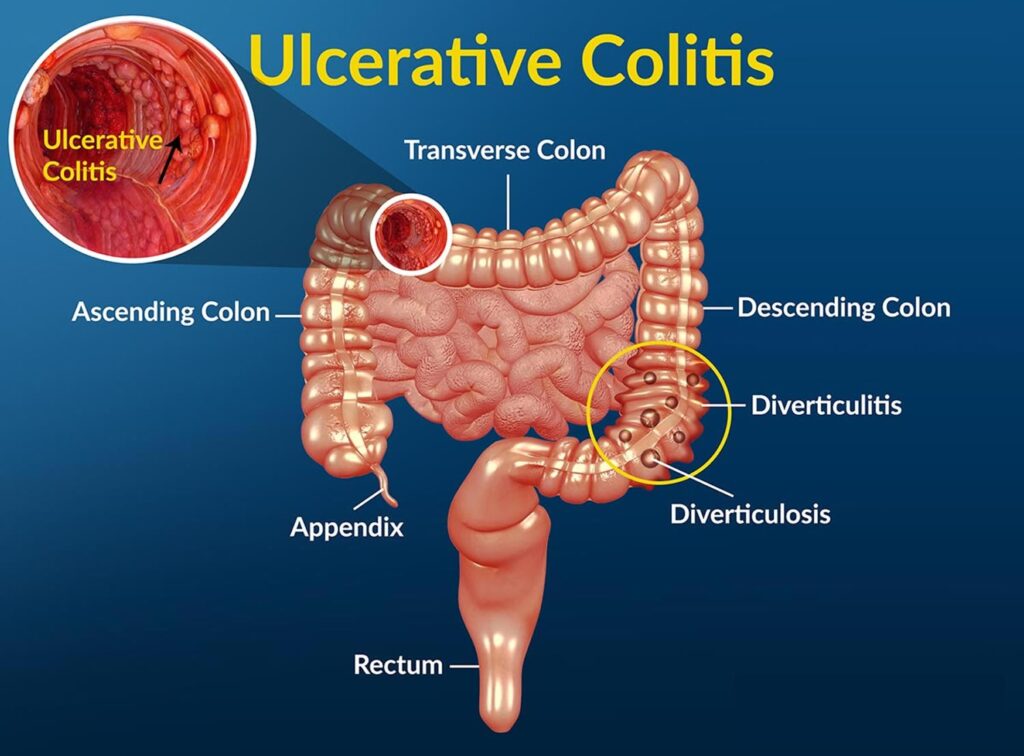 ulcerative-collitis