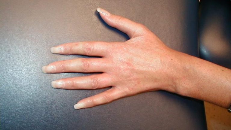 Scleroderma | Chandigarh Ayurved & Panchakarma Centre