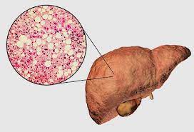 fatty liver home remedies treatment