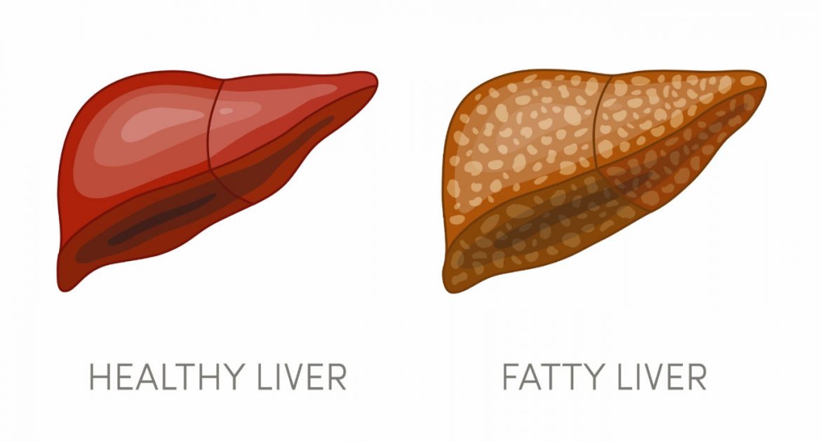 Fatty Liver Home Remedies, Symptoms, Causes & Treatment