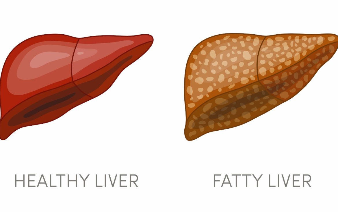 Fatty Liver Home Remedies, Symptoms, Causes & Treatment