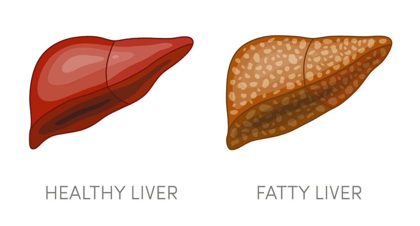 NON ALCOHOLIC FATTY LIVER DISEASE NAFLD AND ITS AYURVEDIC MANAGEMENT non-alcoholic-fatty-liver-disease-nafld-and-its-ayurvedic-management