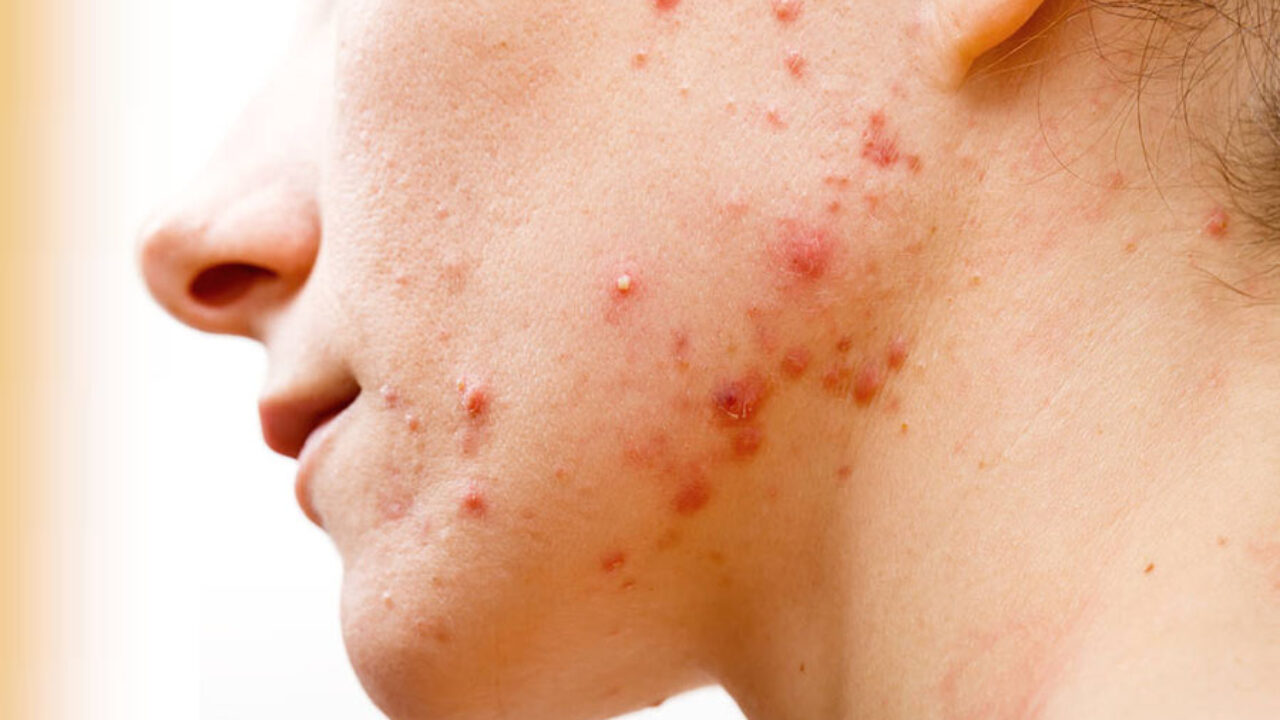 ACNE IN AYURVEDA Chandigarh Ayurved & Panchakarma Centre