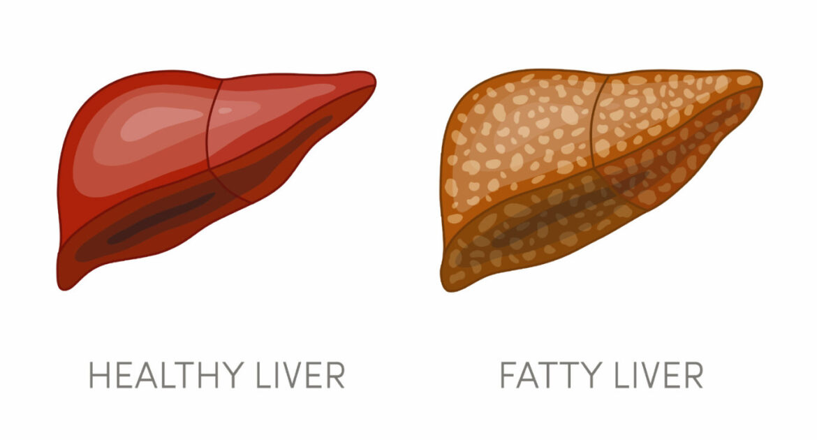 What is fatty Liver Disease, Symptoms, Causes, Treatment