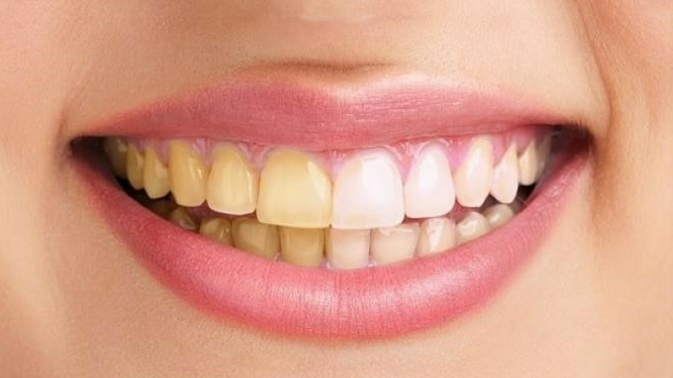 NATURAL TEETH WHITENING TIPS Chandigarh Ayurved & Panchakarma Centre