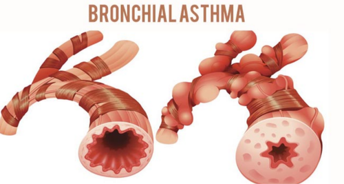 Bronchial Asthma