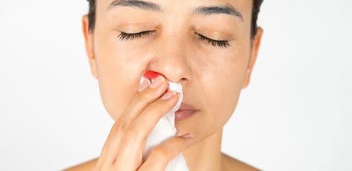Epistaxis