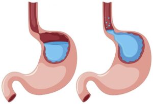 Symptoms of acid reflux disease