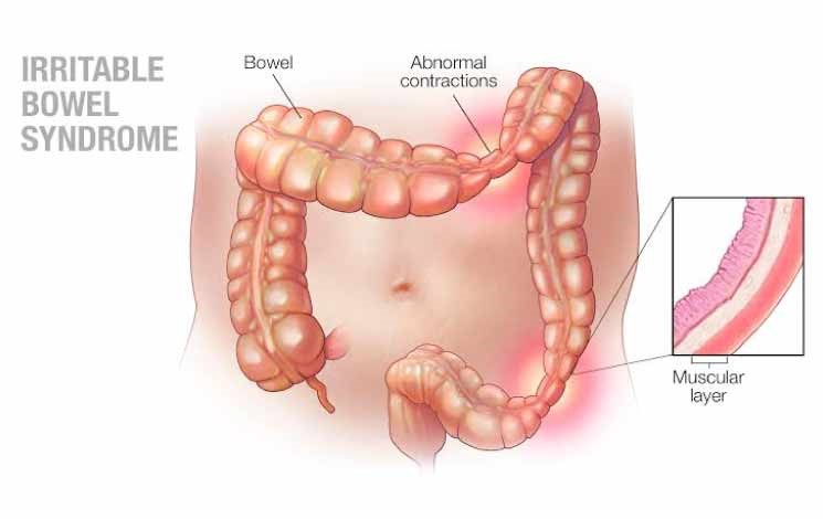 How To Avoid Irritable Bowel Syndrome With Constipation?