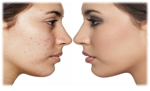 HOW TO REMOVE DARK SPOTS CAUSED BY PIMPLES