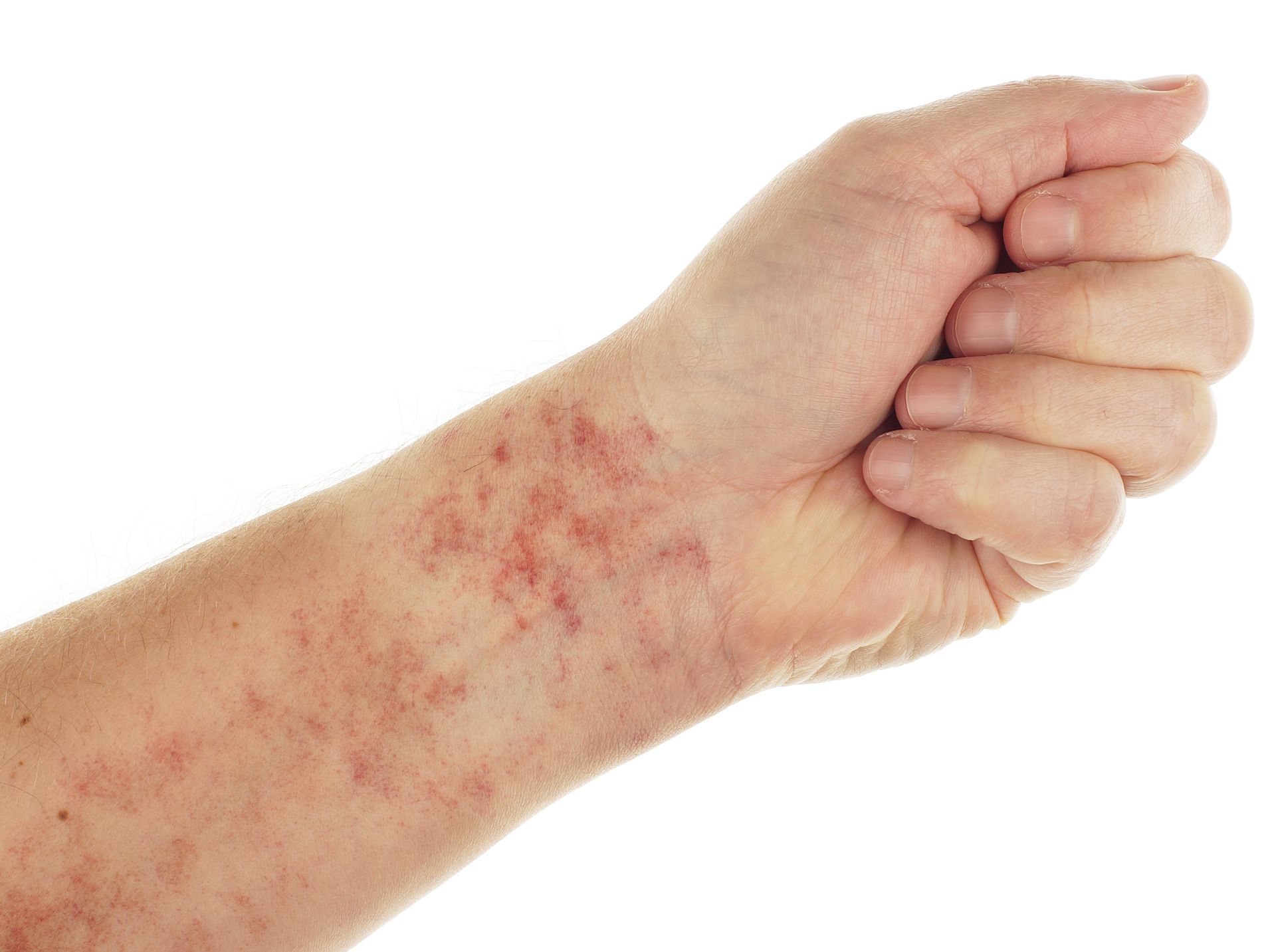 HOME REMEDIES FOR IMMUNE THROMBOCYTOPENIA PURPURA Chandigarh Ayurved