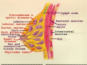 DISORDER ASSOCIATED WITH BREAST