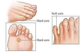 CORNS AND CALLUSES