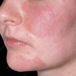 SEBORRHEIC DERMATITIS