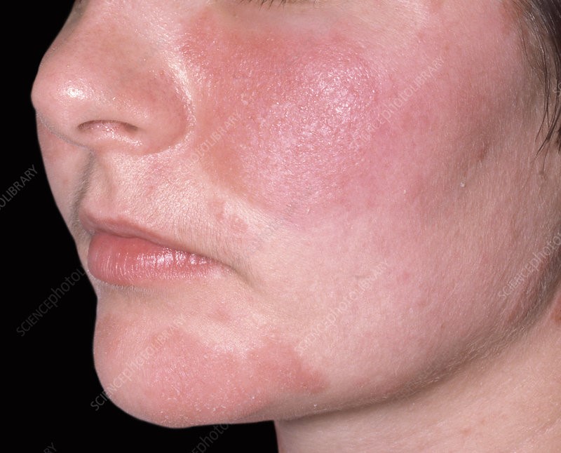 SEBORRHEIC DERMATITIS